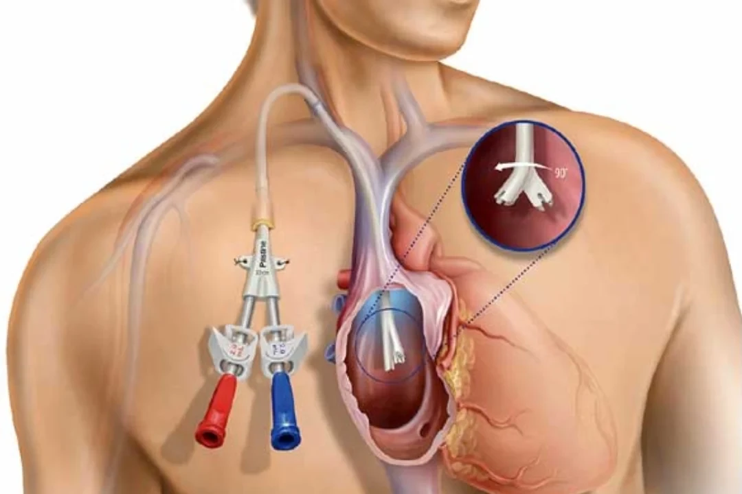 Permacath Insertion